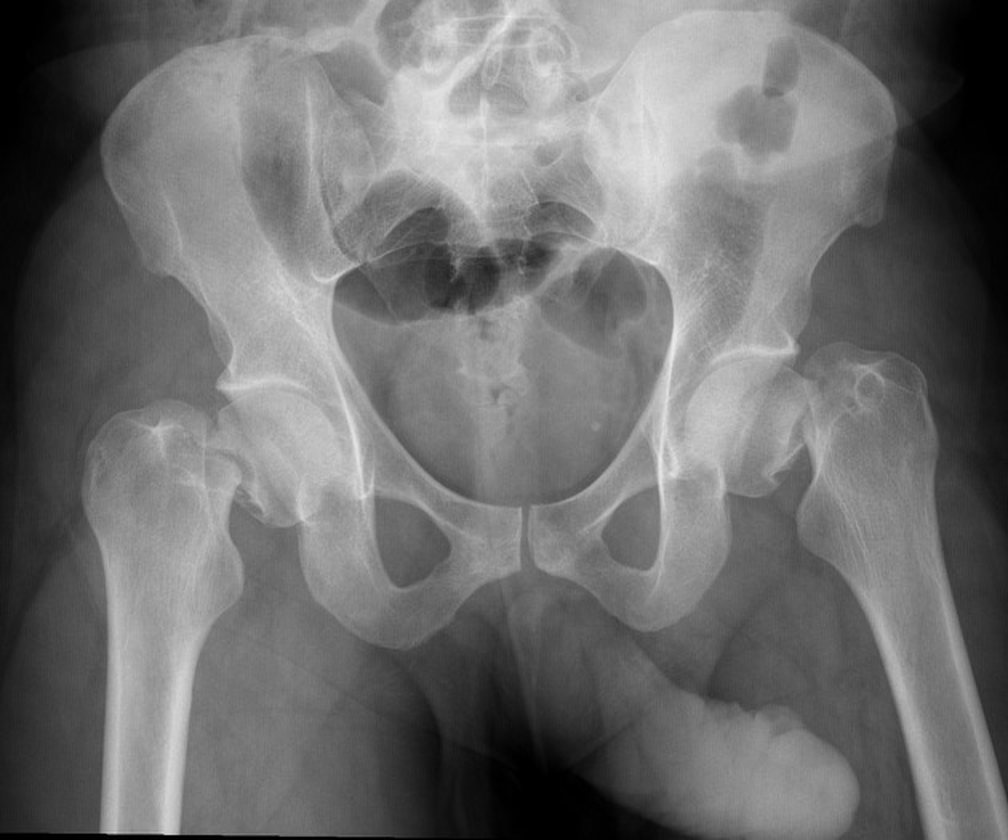Radiografia da bacia em incidência anteroposterior mostrando fratura bilateral do colo do fêmur, com perda do alinhamento normal entre a cabeça e o colo femoral dos dois lados